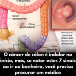 Câncer de cólon: 7 sinais de alerta que você nunca deve ignorar Imagem da página de origem