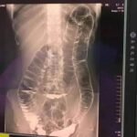 Cólon saturado: quando o corpo dá sinais de alerta Imagem da página de origem