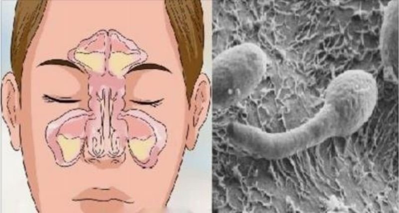 Nariz Entupido? Sua Sinusite Pode Vir do Intestino!