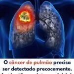 Câncer de Pulmão: Detecção Precoce Salva Vidas 1784ff56-715a-4c6c-b821-1d92cee9d8d1-1