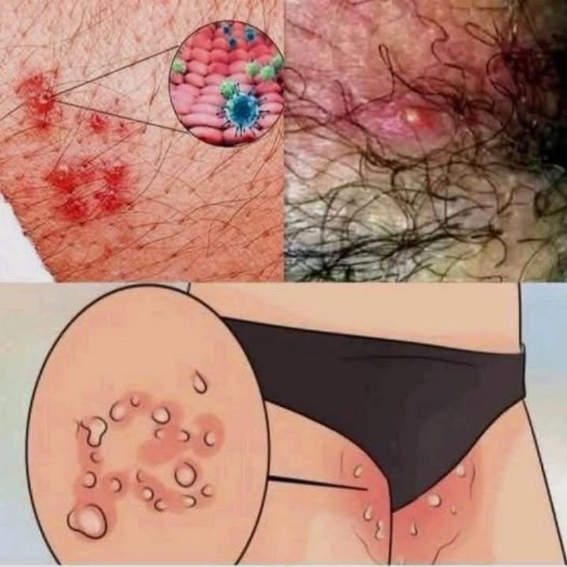 Irritação na Virilha: Sinais, Causas e Soluções