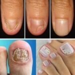 Diga Adeus à Onicomicose: Remédios Caseiros Eficazes para Unhas Saudáveis 3e2ba33c-11df-45ed-a595-e5a55821b145