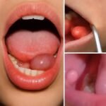 Bolinhas na Boca: Um Guia Completo sobre as Causas, Sintomas e Quando Procurar Ajuda 480fce47-2ede-4503-86f8-a1938fcc8778