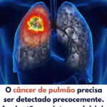 Câncer de Pulmão: Sinais Iniciais Podem Salvar Vidas 6616308a-8694-4df9-95a4-78162179886b