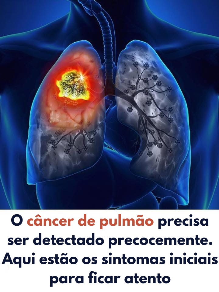 Câncer de Pulmão: Sinais Iniciais Podem Salvar Vidas
