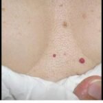 Angiomas de Cereja: O Que São e Como a Natureza Pode Aliá-los 67b2b7d9-3af6-4cb3-b023-d0d9fedffb90