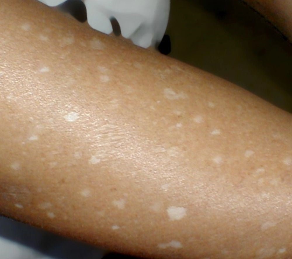 Manchas Brancas na Pele: Desvende e Ajuda a Sua Saúde