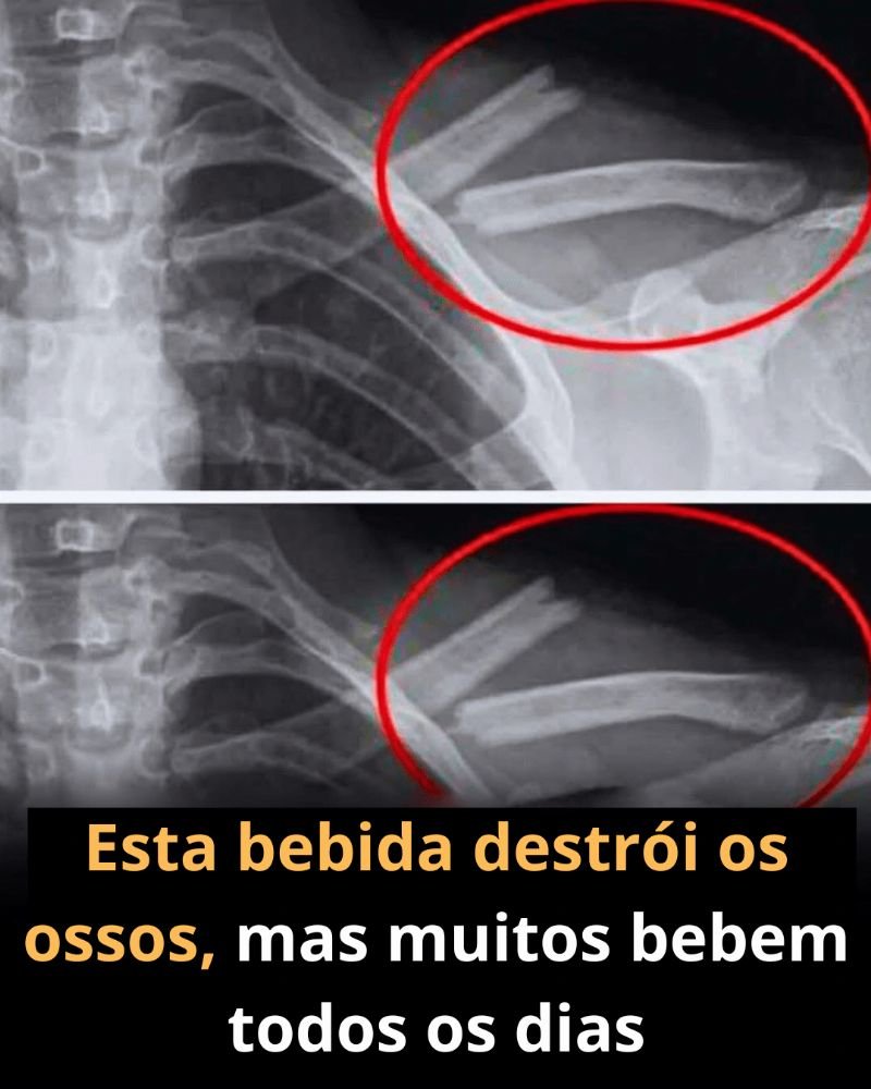 Refrigerante e Ossos: O Impacto Silencioso Revelado!