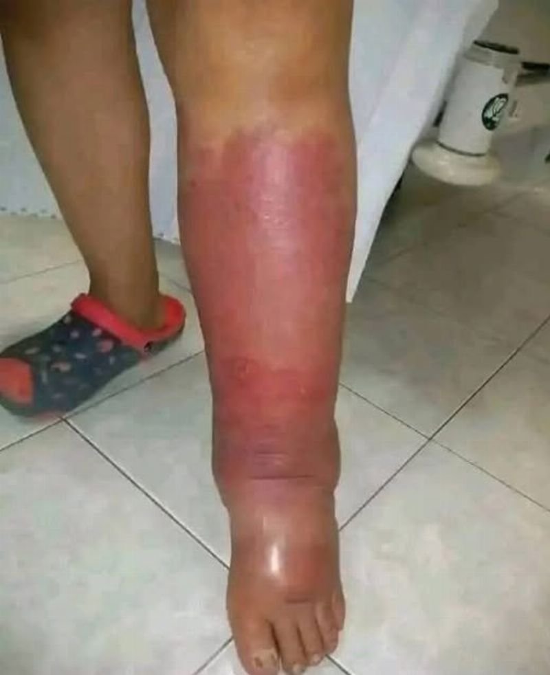 Inflamação: Sintomas e Tratamento Natural Eficaz