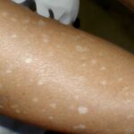 Manchas Brancas na Pele: Sinais, Causas e Como Agir 6eb20790-0562-4f96-9336-da35a743c07c