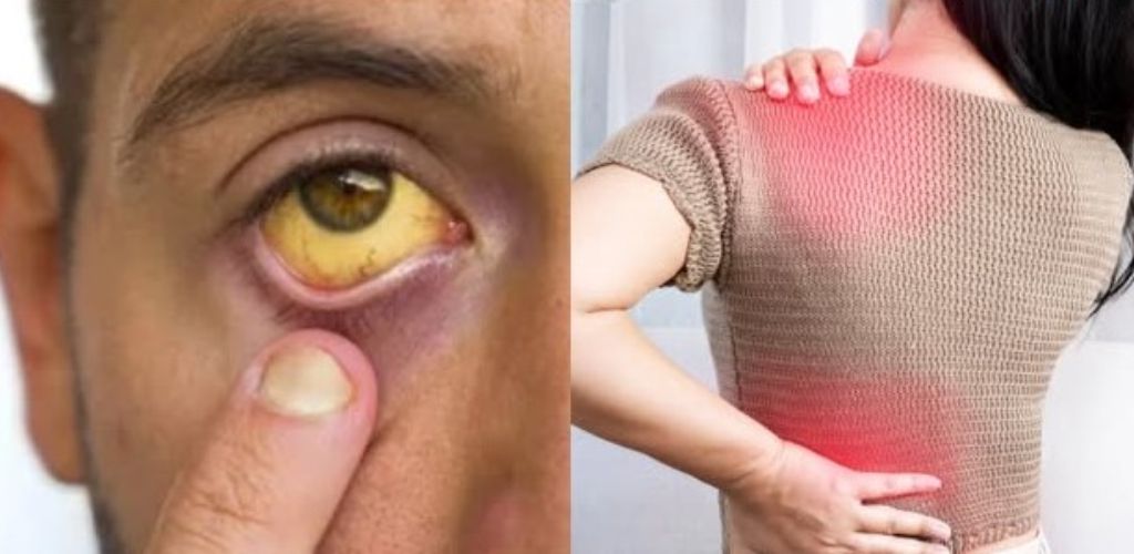 Cancro do Pâncreas: Sinais de Alerta para Detecção Precoce