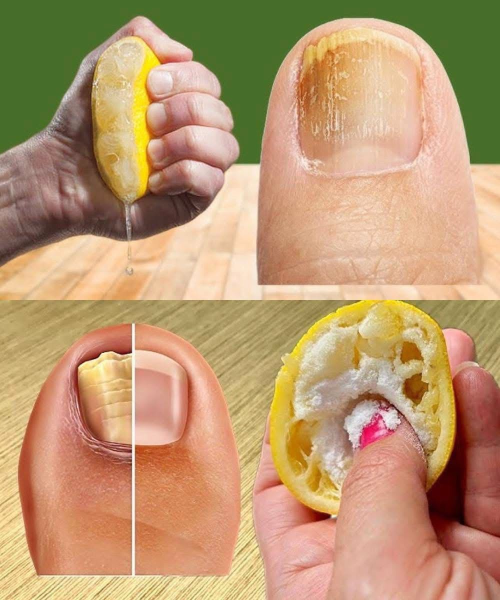 Livre-se dos Fungos nas Unhas de Forma Natural e Eficaz!