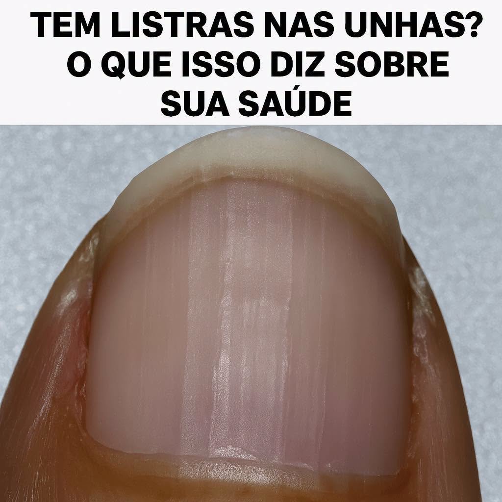 Estrias nas Unhas: Desvende o Que Elas Comunicam Sobre Sua Saúde