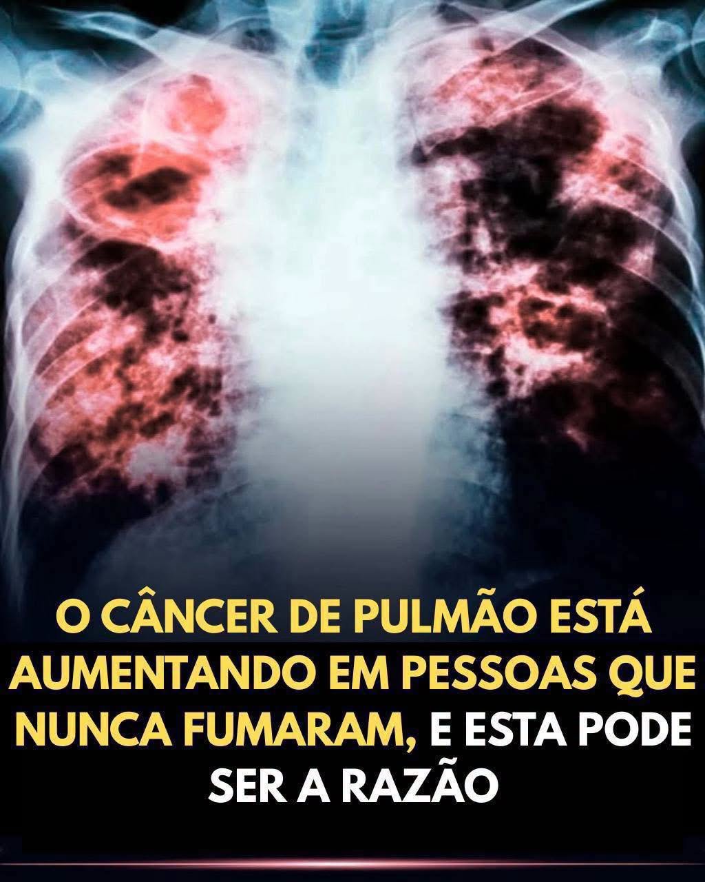 Câncer de Pulmão em Não Fumantes: O Alerta Urgente!